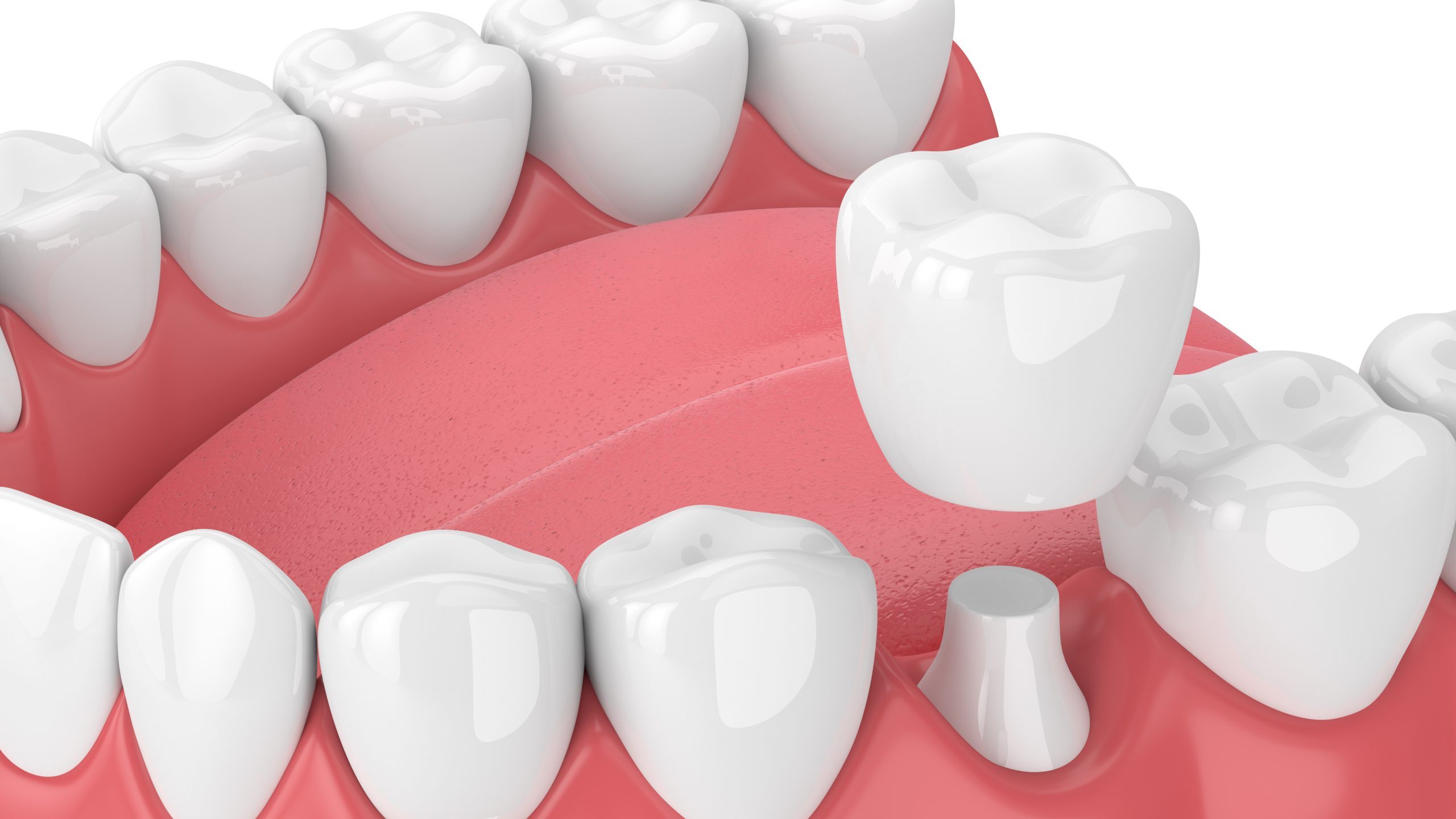 3d render of jaw with teeth and dental crown restoration 3d render of jaw with teeth and dental crown restoration over white background